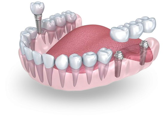 Implante Dentario Simioni.png - Simioni Clínica Odontológica