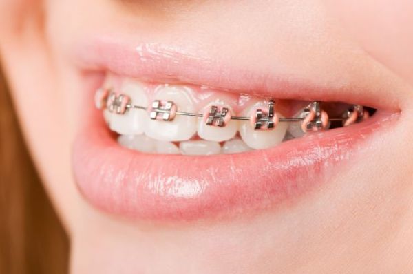Aparelho Mancha Os Dentes - Simioni Clínica Odontológica