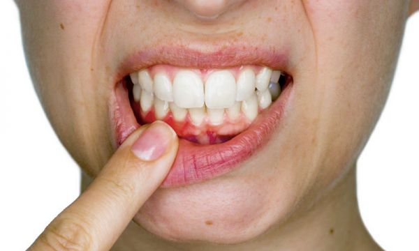Como Evitar Cáries - Simioni Clínica Odontológica