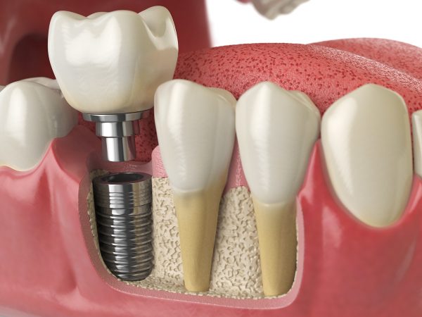 Implante Dentário - Simioni Clínica Odontológica