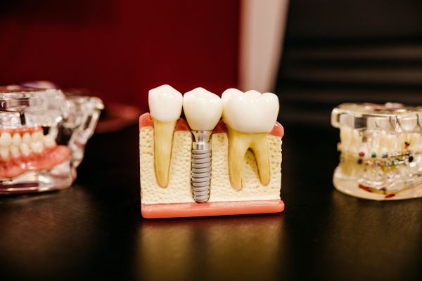 implante dentário -simioni clinic