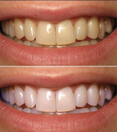 Clareamento Dental A Laser Antes E Depois 01.jpg - Simioni Clínica Odontológica