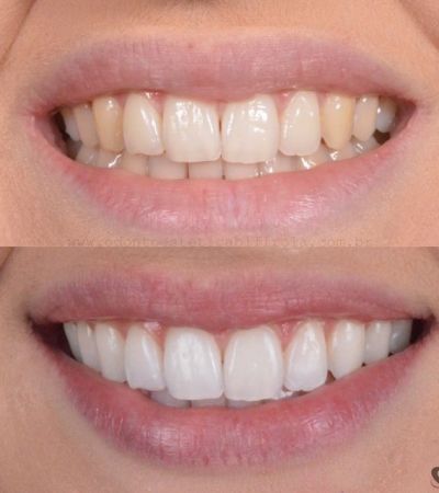 Clareamento Dental Fortaleza Antes Depois Casoclinico Valor Dentista 2.jpg - Simioni Clínica Odontológica