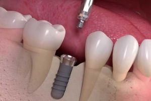 Implantes Dentarios 2.jpg - Simioni Clínica Odontológica