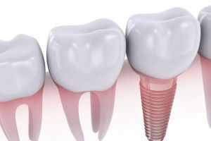 Implantes Dentarios 3.jpg - Simioni Clínica Odontológica