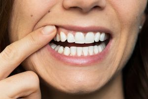 Implantes Dentarios 7.jpg - Simioni Clínica Odontológica