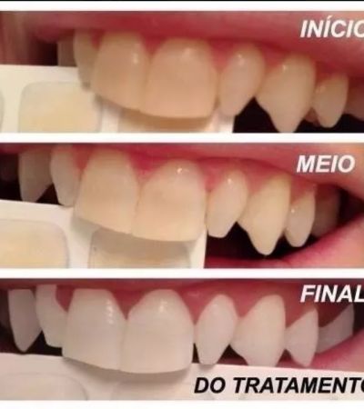 Kit Clareamento Dental 44 6 Seringas 2 Pares Moldeira Led D Nq Np 993272 Mlb29422194915 022019 F.jpg - Simioni Clínica Odontológica